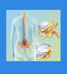 Physiotherapy For Lower Back Pain In Noida
