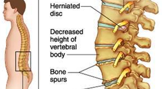 Physiotherapy For Slipped Disc In Noida